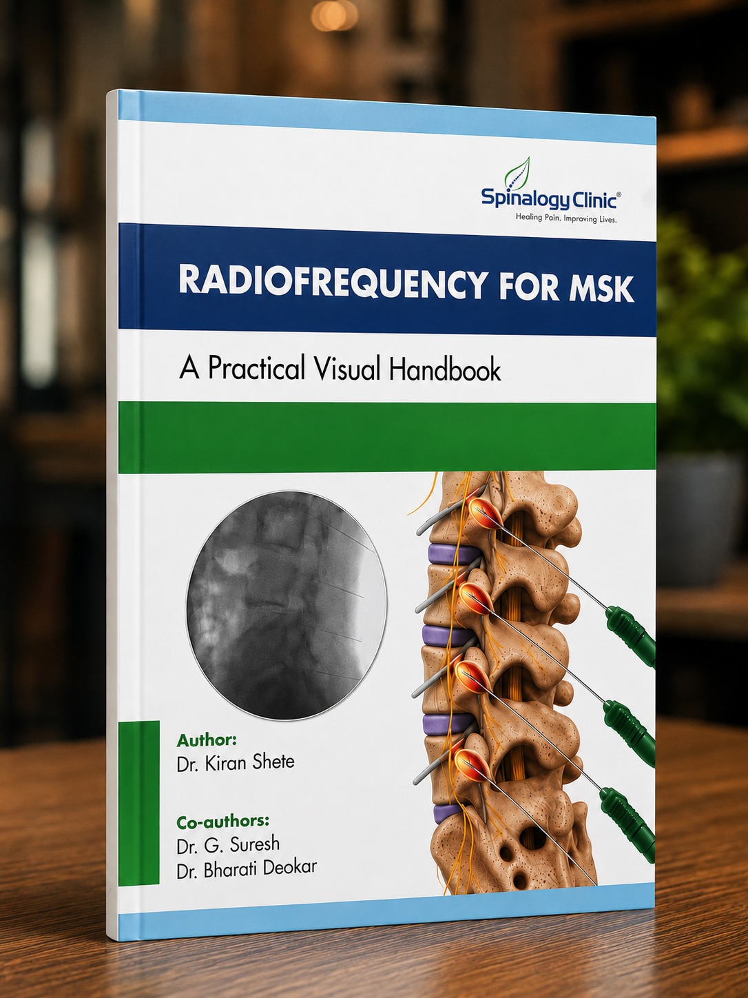 Radiofrequency for MSK